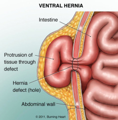 2014-01-02-ventralhernia.jpg