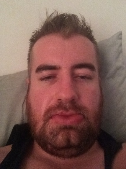 2014-04-03-EricBarryJawWiredShutSurgerySwelling.jpeg