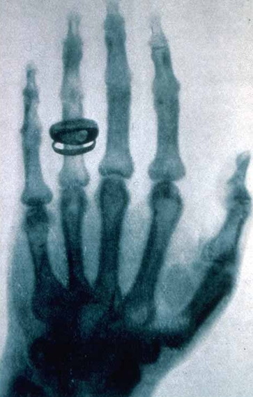 2014-05-01-Xray_by_Wilhelm_Rntgen_of_Albert_von_Kllikers_hand__1896012302.jpg