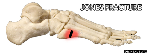 jones fracture foot