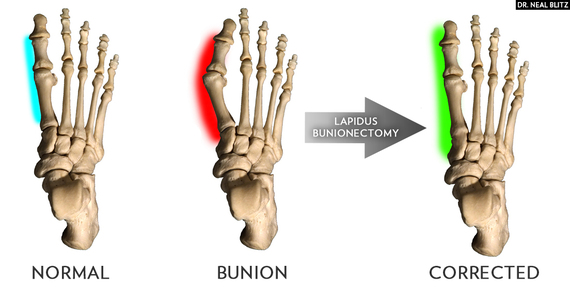 2014-11-14-LapidusBunionectomyDrBlitz.jpg