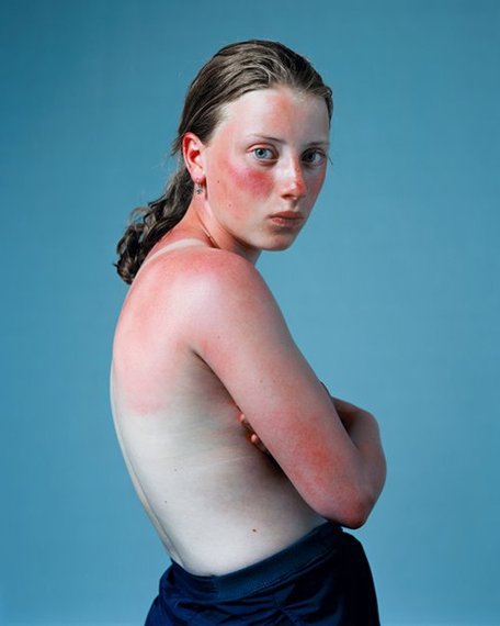 2014-11-18-Sunburn.jpg