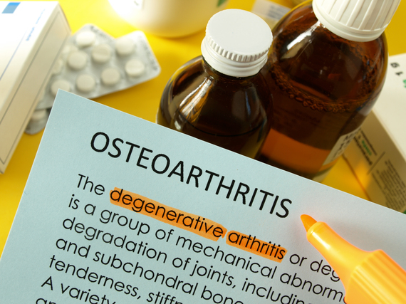 2014-11-18-osteoarthritisbesttreatment_85564618.jpg