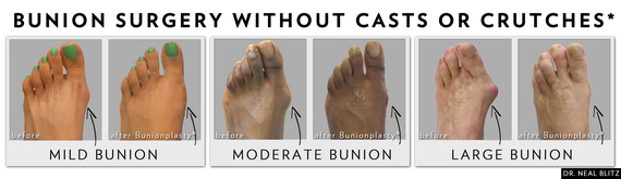 bunion surgery recovery shoes