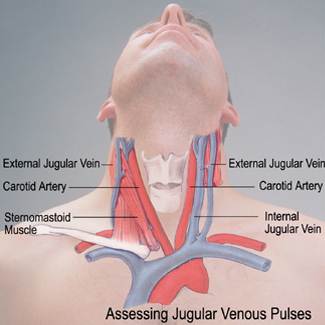 carotid versus jugular venous distention