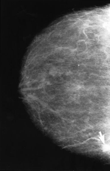 2015-02-23-Mammogram2.jpg