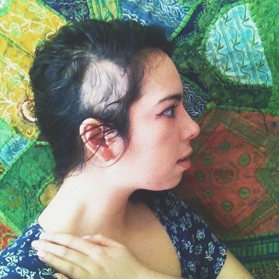 2015-03-25-1427308072-8218461-alopecia.jpg