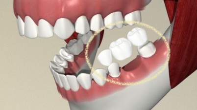 calculus bridge teeth removal