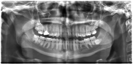 2015-12-29-1451397095-7351472-Dental_Xrays.JPG