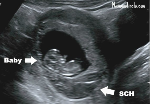 Subchorionic Hematoma Size Chart