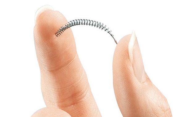 2016-07-06-1467774444-101067-essure.jpg