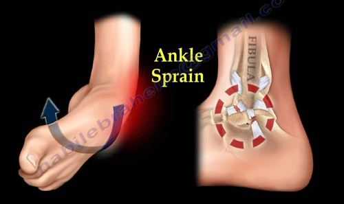 2016-08-24-1472069616-3806197-ankle5.PNG