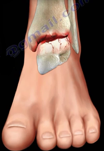 2016-08-24-1472069759-8900477-ankle12.PNG