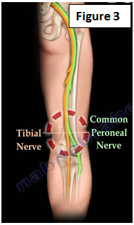 peroneal nerve foot drop