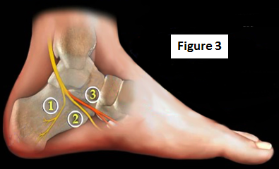 2016-11-09-1478705571-1854440-mortonneuroma3.PNG