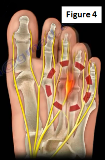 Image result for Mortonâs neuroma