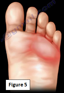 2016-11-09-1478705607-6485878-mortonneuroma5.PNG