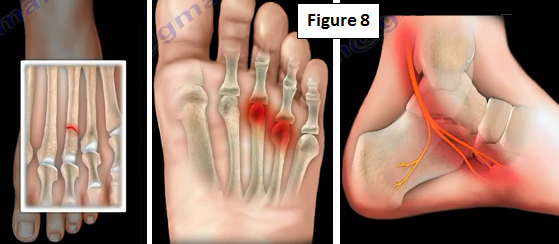 2016-11-09-1478705682-3100082-mortonneuroma8.PNG