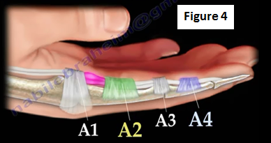 thumb finger trigger injection sheath technique tendon flexor huffpost