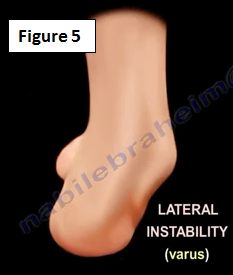 2016-12-20-1482261109-8220500-ankleinstability5.PNG