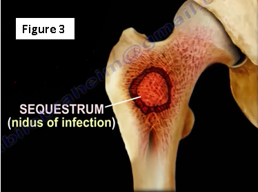 2017-01-26-1485452707-9158495-osteomyelitis3.PNG