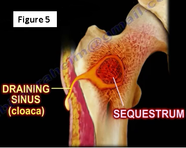 2017-01-26-1485452750-5363059-osteomyelitis5.PNG