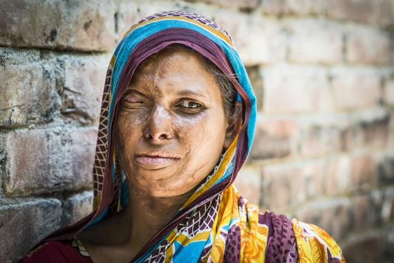 How Acid Attacks Impact Women And Girls Worldwide