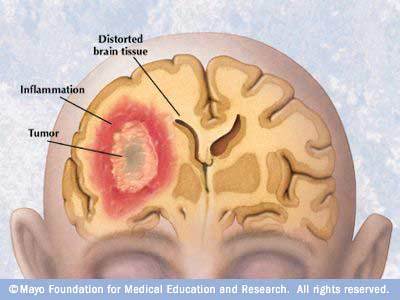 brain look tumors rays symptoms mayoclinic had them who